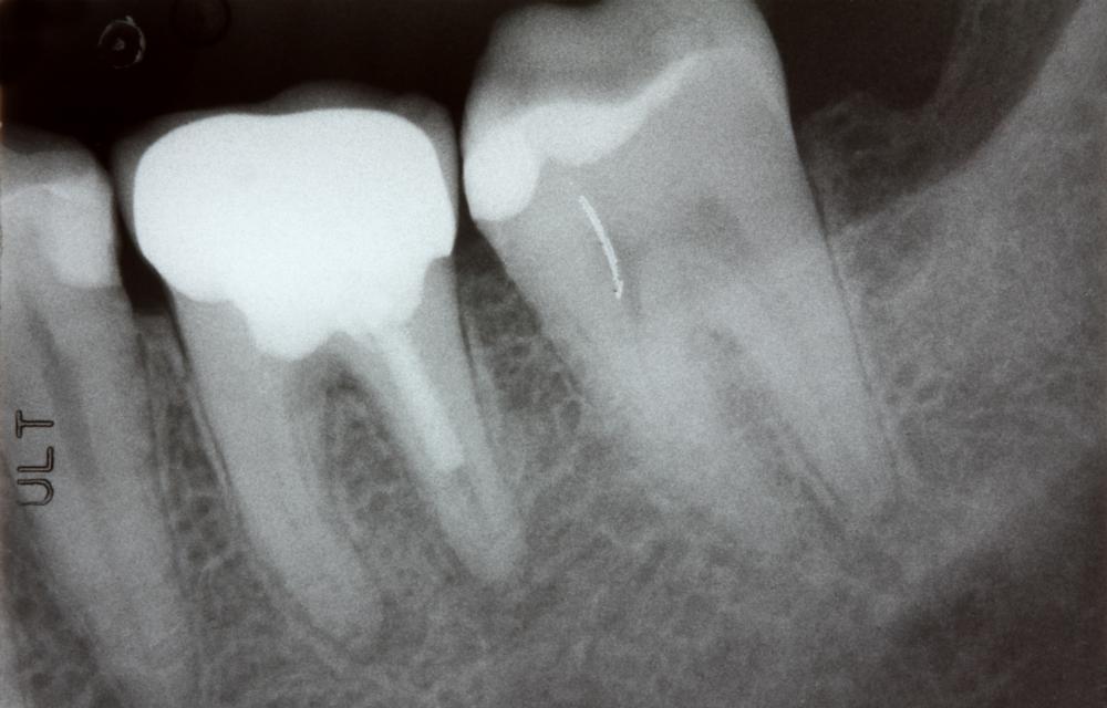 Winston-Salem dental patient receiving a low-radiation digital dental x-ray