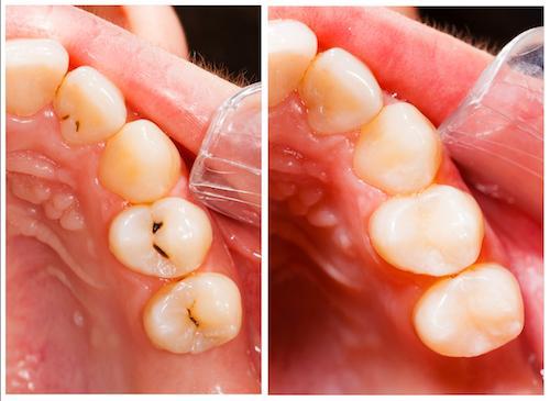 Close up of patients mouth with tooth decay and after tooth colored fillings in Winston Salem NC